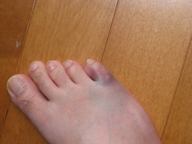 Fractured Little Toe